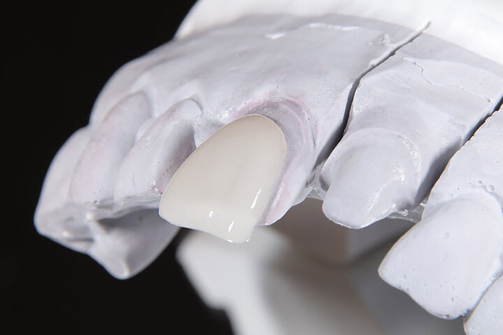 ラミネートべニア