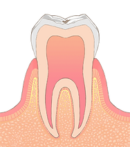 C0 歯の表面がわずかに溶けている状態