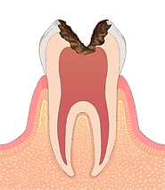C3 虫歯菌が歯髄まで侵入した状態