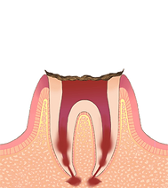C4 歯が崩壊した状態