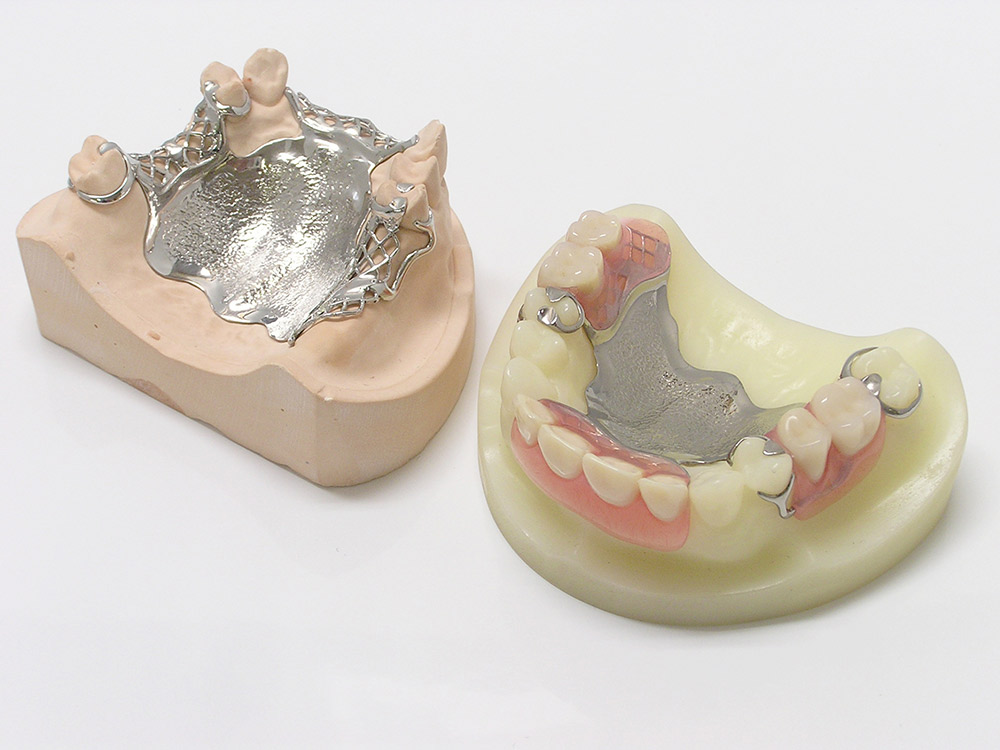 チタン床義歯