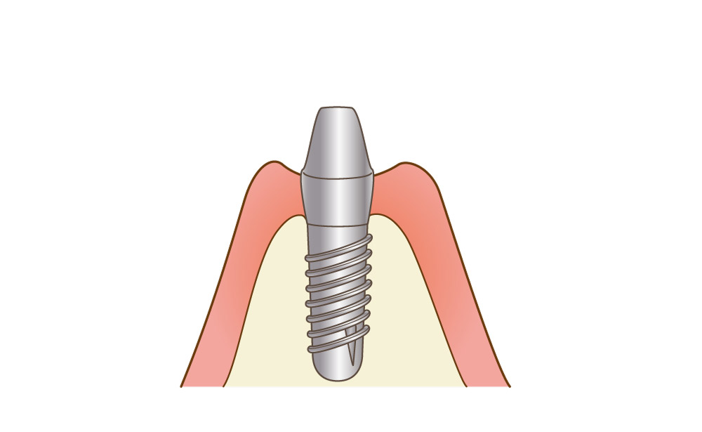 インプラント体（人工歯根）