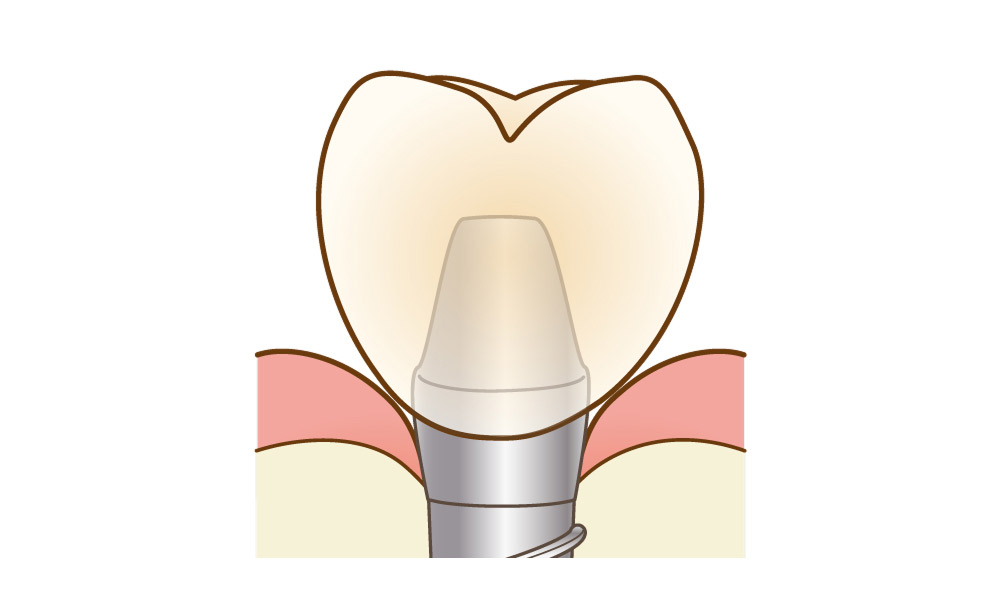 上部構造（人工歯）
